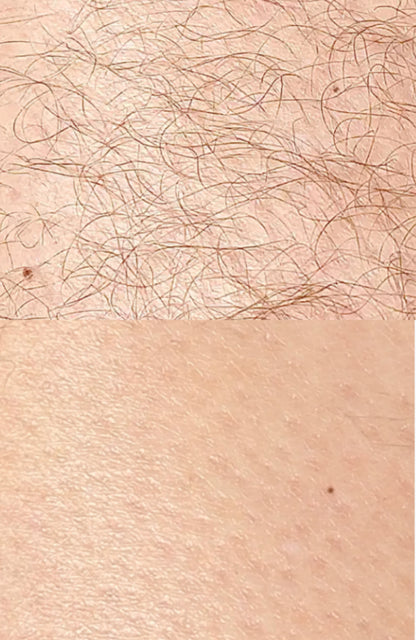 ANSWR Exfoliating Hair Removal Drop
